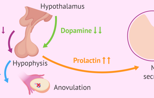 hyperprolactinemia هیپرپرولاکتینمی