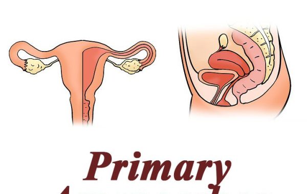 آمنوره اولیه Primary Amenorrhea
